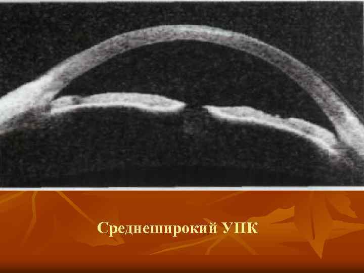 Среднеширокий УПК 