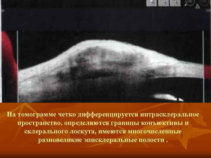 На томограмме четко дифференцируется интрасклеральное пространство, определяются границы конъюктивы и склерального лоскута, имеются многочисленные