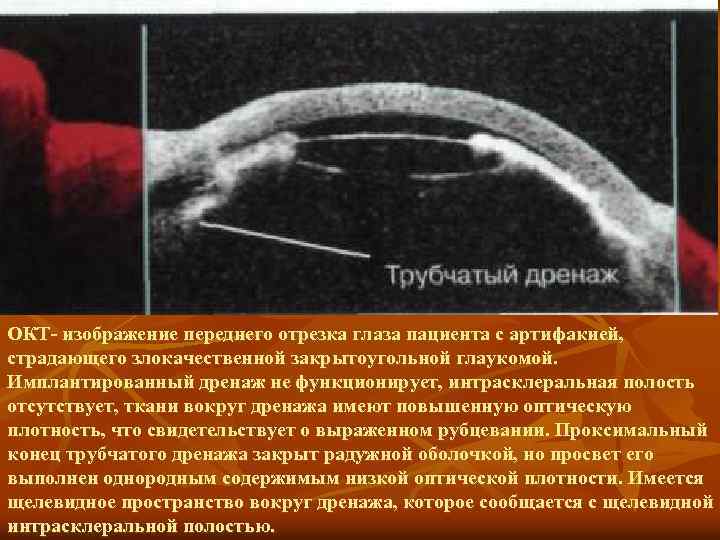 Отсутствовать полость. Оптическая когерентная томография переднего отрезка глаза. Окт переднего отрезка глаза. Визуализация переднего отрезка глаза. Новообразования переднего отрезка глаза.