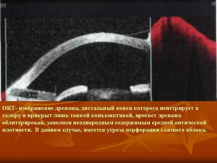 ОКТ- изображение дренажа, дистальный конец которого пенетрирует в склеру и прикрыт лишь тонкой конъюнктивой,