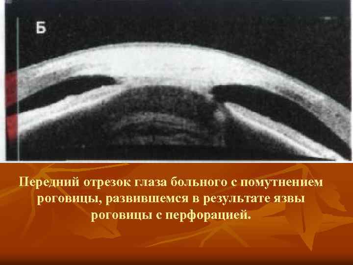 Передний отрезок глаза больного с помутнением роговицы, развившемся в результате язвы роговицы с перфорацией.