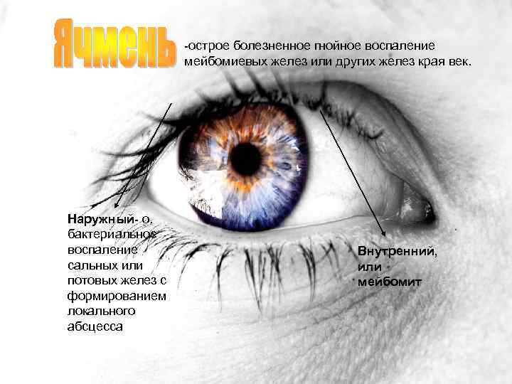 -острое болезненное гнойное воспаление мейбомиевых желез или других желез края век. Наружный- о. бактериальное