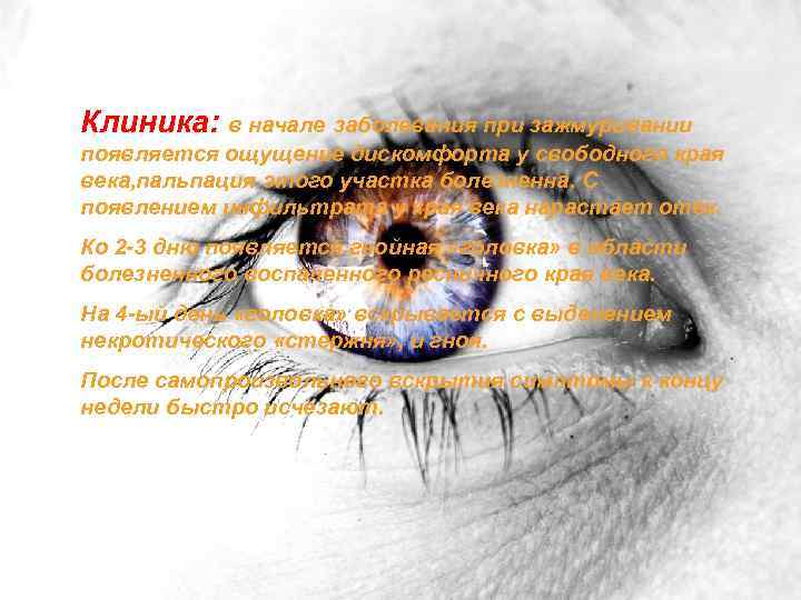 Клиника: в начале заболевания при зажмуривании появляется ощущение дискомфорта у свободного края века, пальпация