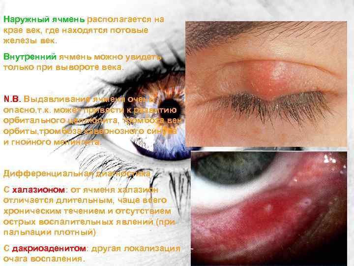 Наружный ячмень располагается на крае век, где находятся потовые железы век. Внутренний ячмень можно