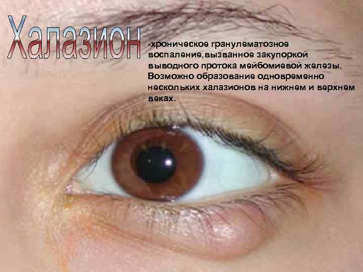 -хроническое гранулематозное воспаление, вызванное закупоркой выводного протока мейбомиевой железы. Возможно образование одновременно нескольких халазионов