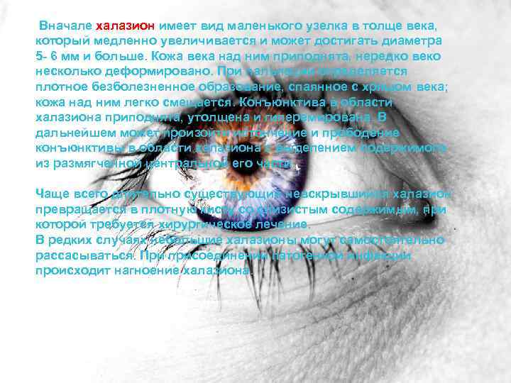 Вначале халазион имеет вид маленького узелка в толще века, который медленно увеличивается и может