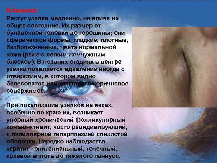 Клиника: Растут узелки медленно, не влияя на общее состояние. Их размер от булавочной головки