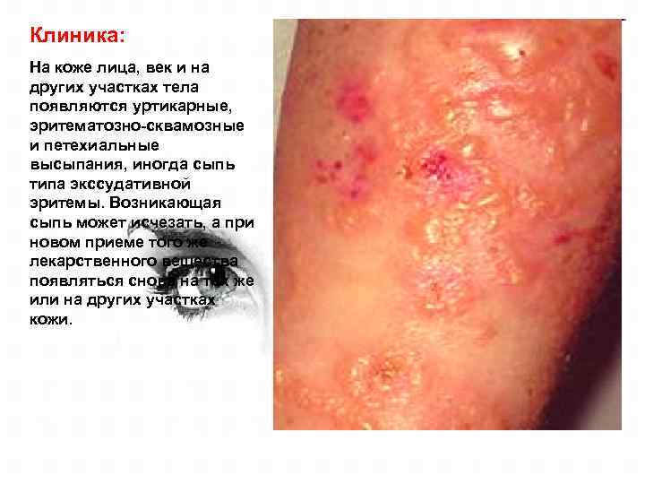 Клиника: На коже лица, век и на других участках тела появляются уртикарные, эритематозно-сквамозные и
