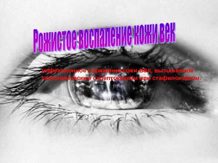 инфекционное поражение кожи век, вызываемое гемолитическим стрептококком или стафилококком. 