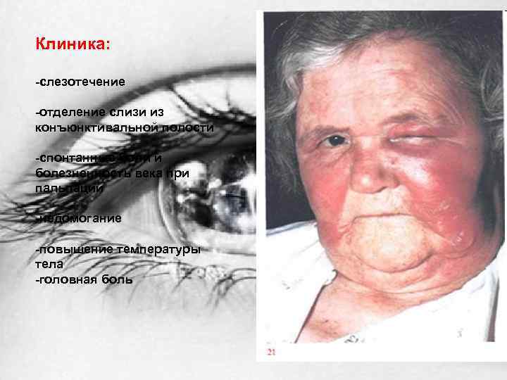 Клиника: -слезотечение -отделение слизи из конъюнктивальной полости -спонтанные боли и болезненность века при пальпации