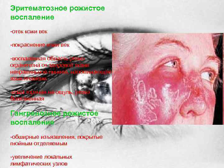 Эритематозное рожистое воспаление -отек кожи век -покраснение кожи век -воспаленная область резко ограничена от