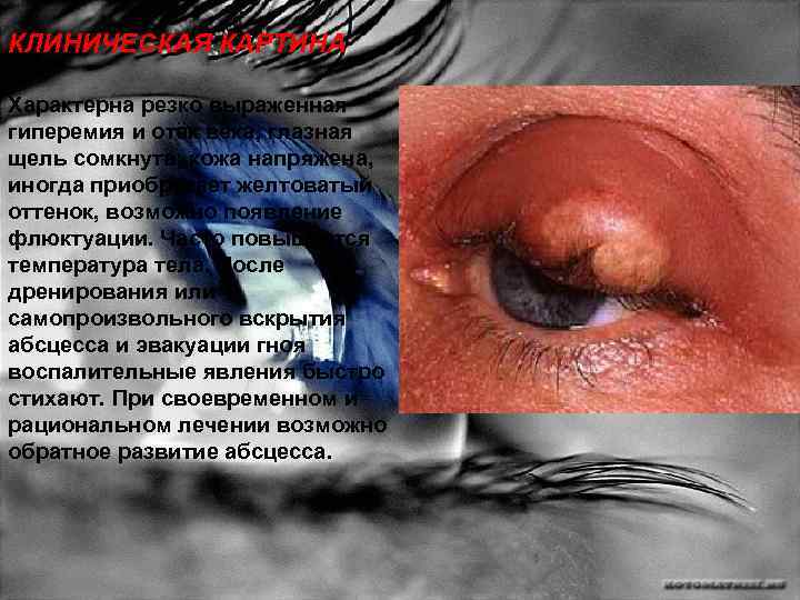КЛИНИЧЕСКАЯ КАРТИНА Характерна резко выраженная гиперемия и отёк века, глазная щель сомкнута; кожа напряжена,