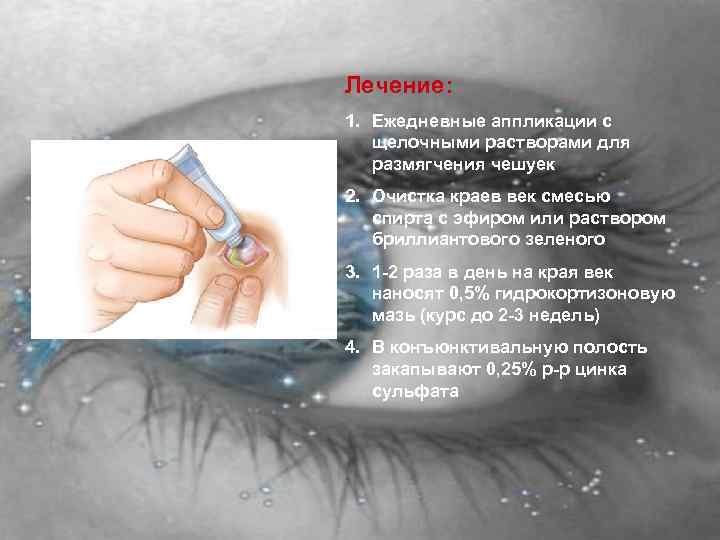 Лечение: 1. Ежедневные аппликации с щелочными растворами для размягчения чешуек 2. Очистка краев век