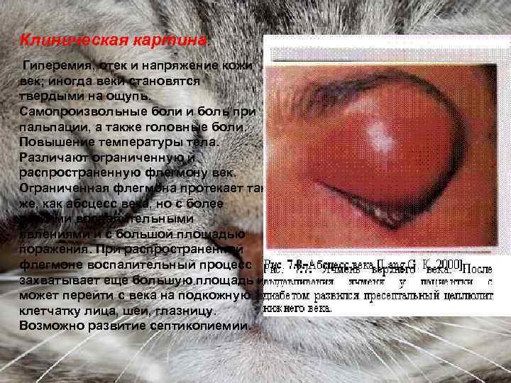 Клиническая картина. Гиперемия, отек и напряжение кожи век; иногда веки становятся твердыми на ощупь.