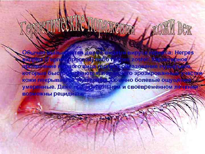 Обычно вызываются двумя видами вируса герпеса: Herpes simplex (Герпес простой) либо Herpes zoster. Характерное