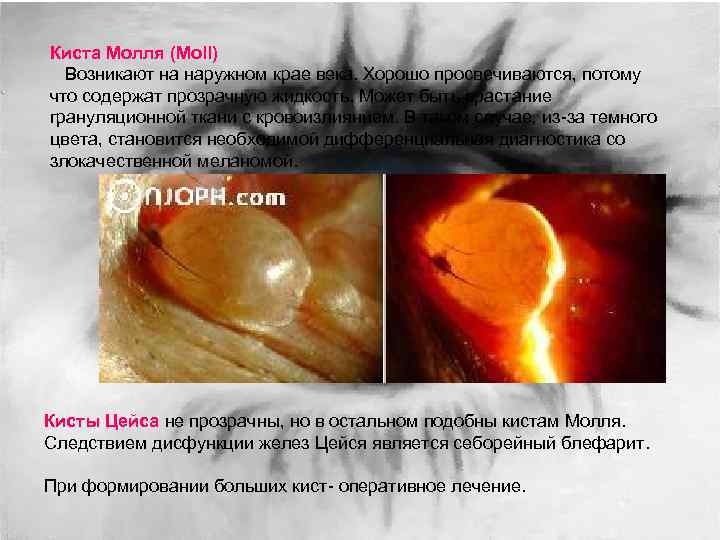 Киста Молля (Moll) Возникают на наружном крае века. Хорошо просвечиваются, потому что содержат прозрачную