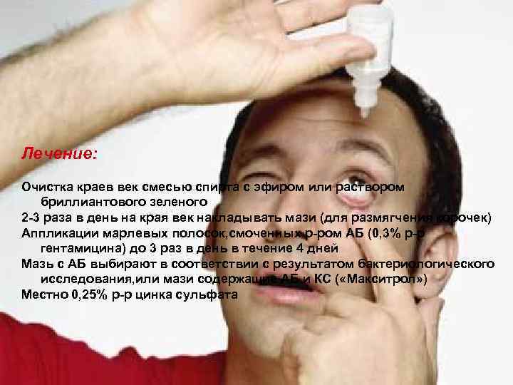 Лечение: Очистка краев век смесью спирта с эфиром или раствором бриллиантового зеленого 2 -3