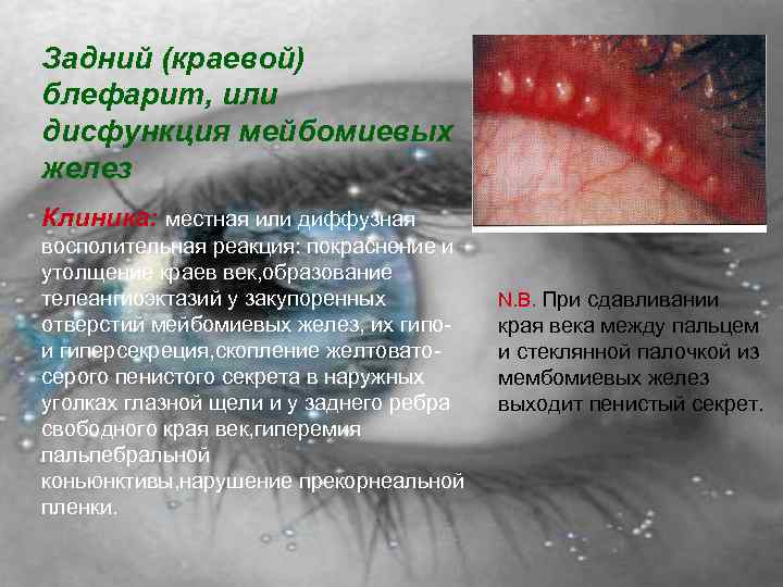 Задний (краевой) блефарит, или дисфункция мейбомиевых желез Клиника: местная или диффузная восполительная реакция: покраснение
