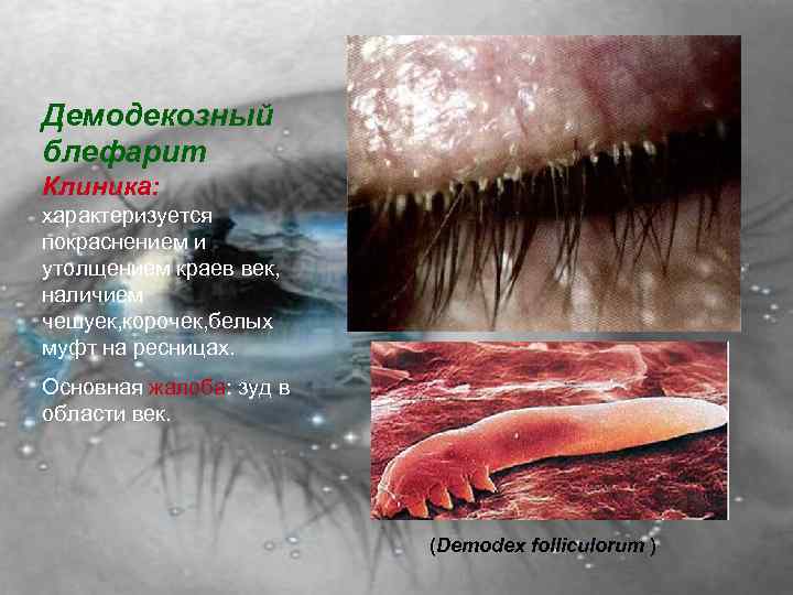 Демодекозный блефарит Клиника: характеризуется покраснением и утолщением краев век, наличием чешуек, корочек, белых муфт