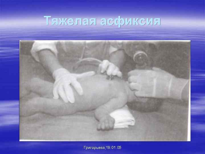 Тяжелая асфиксия Григорьева, 19. 01. 05 