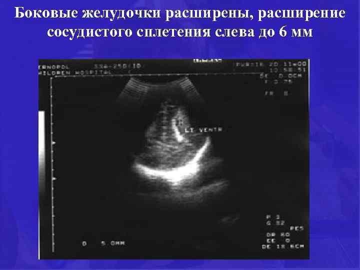 Боковые желудочки расширены, расширение сосудистого сплетения слева до 6 мм 