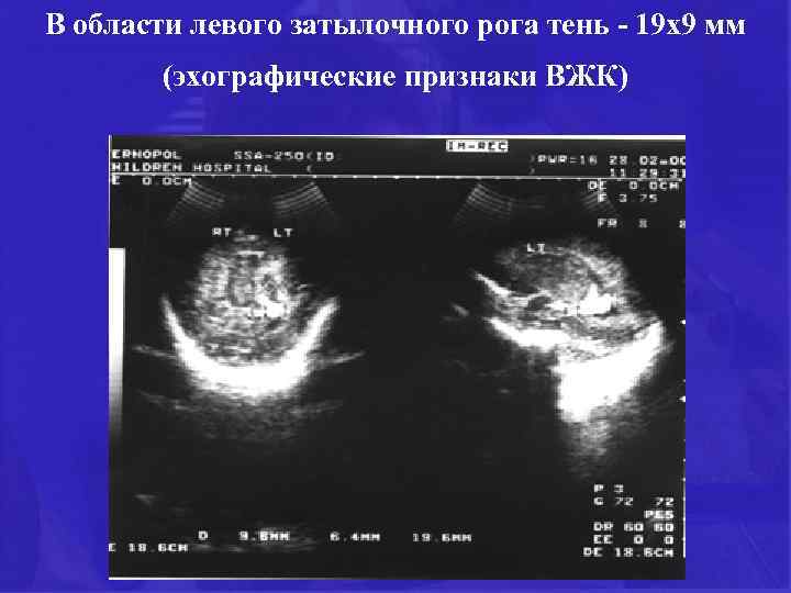 В области левого затылочного рога тень - 19 х9 мм (эхографические признаки ВЖК) 