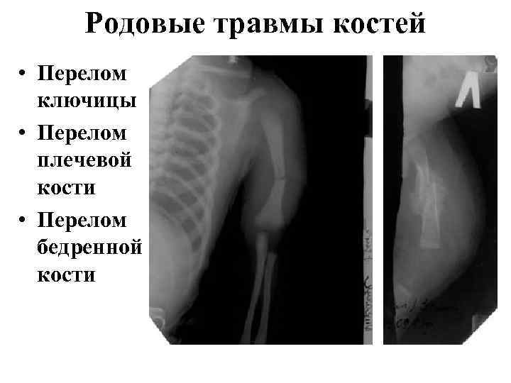 Родовые травмы костей • Перелом ключицы • Перелом плечевой кости • Перелом бедренной кости
