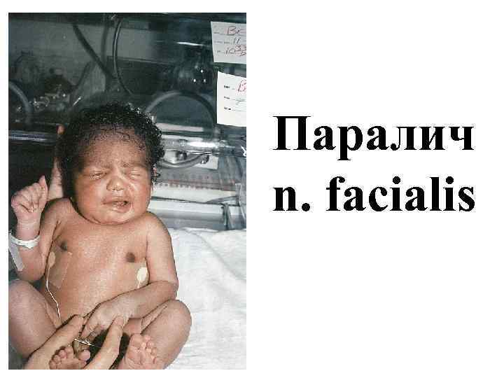 Паралич n. facialis 