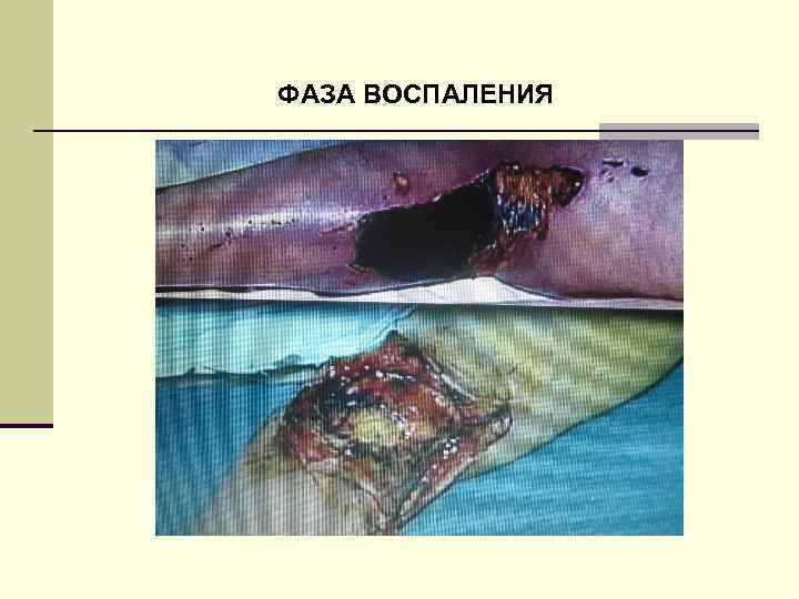 ФАЗА ВОСПАЛЕНИЯ 