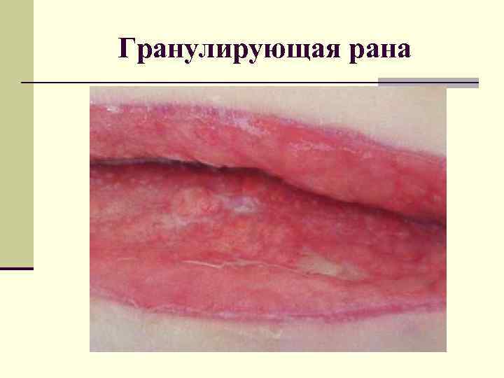 Гранулирующая рана 