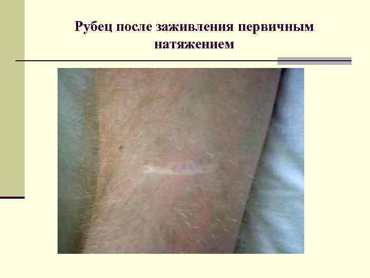 Рубец после заживления первичным натяжением 
