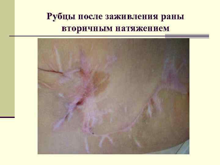 Рубцы после заживления раны вторичным натяжением 