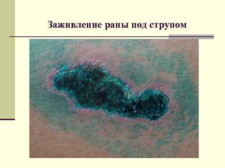 Заживление раны под струпом 