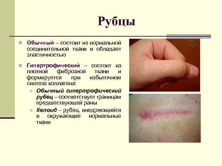 Рубцы Обычный – состоит из нормальной соединительной ткани и обладает эластичностью Гипертрофический – состоит