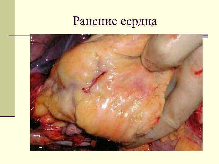 Ранение сердца 