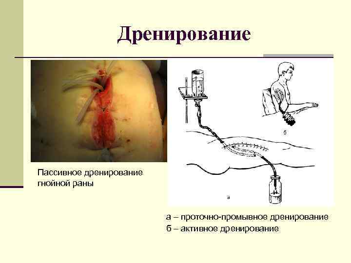 Дренирование Пассивное дренирование гнойной раны а – проточно-промывное дренирование б – активное дренирование 