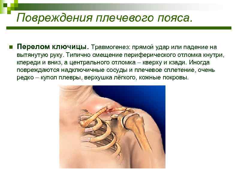 Повреждения плечевого пояса. n Перелом ключицы. Травмогенез: прямой удар или падение на вытянутую руку.