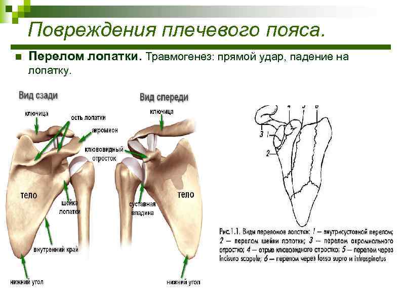 Перелом лопатки