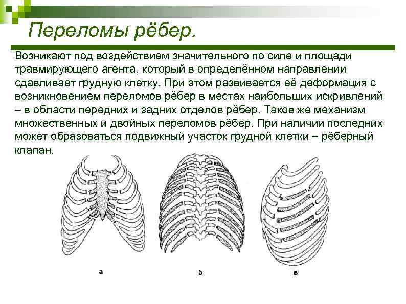 Как лечат ребра