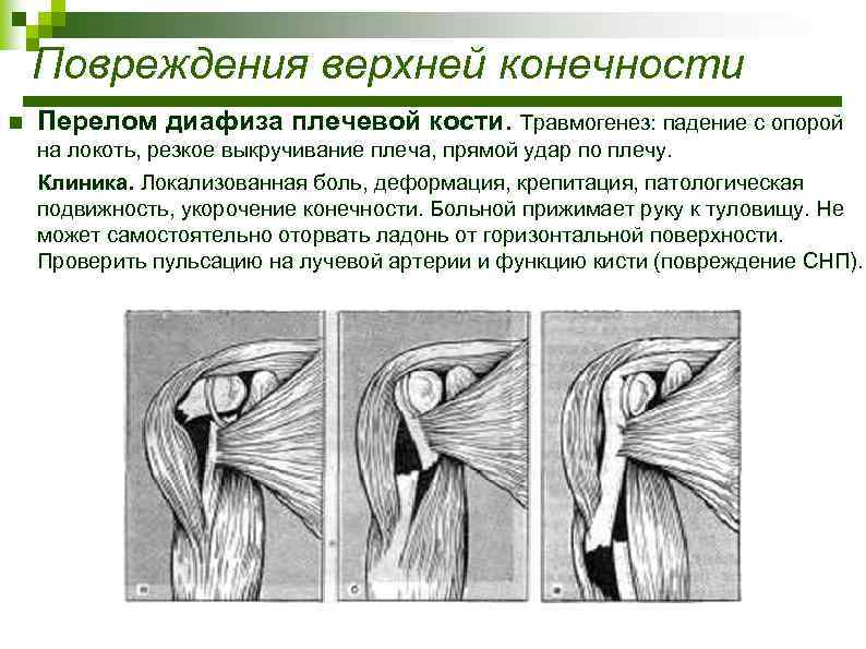 Повреждения верхней конечности n Перелом диафиза плечевой кости. Травмогенез: падение с опорой на локоть,