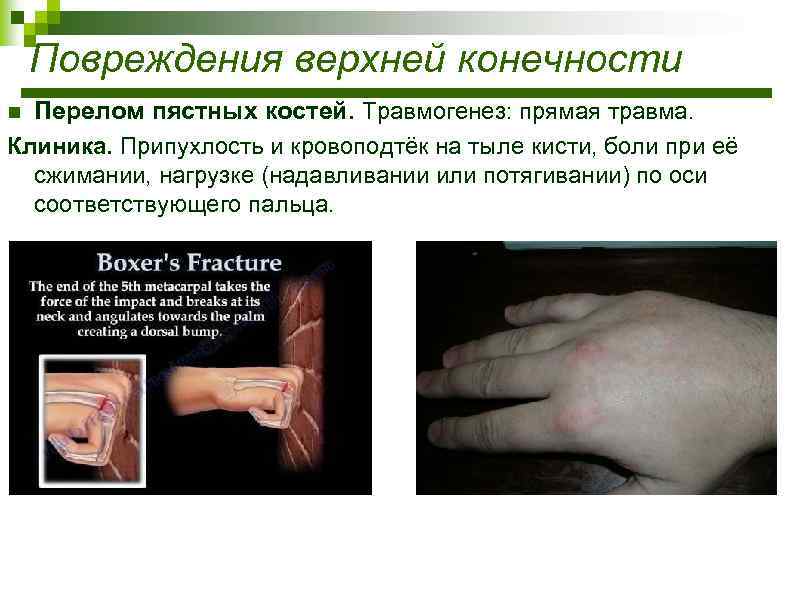 Повреждения верхней конечности Перелом пястных костей. Травмогенез: прямая травма. Клиника. Припухлость и кровоподтёк на