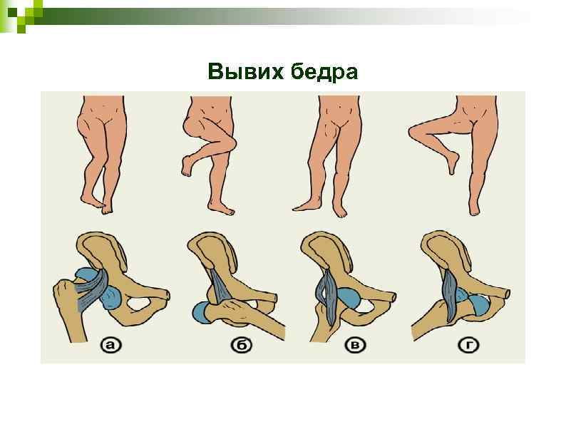 Вывихи тазобедренного сустава классификация. Вывихи бедра классификация. Травматические вывихи бедра: классификация.