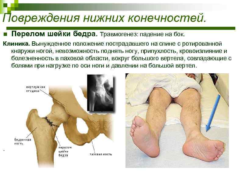 Повреждения нижних конечностей. n Перелом шейки бедра. Травмогенез: падение на бок. Клиника. Вынужденное положение