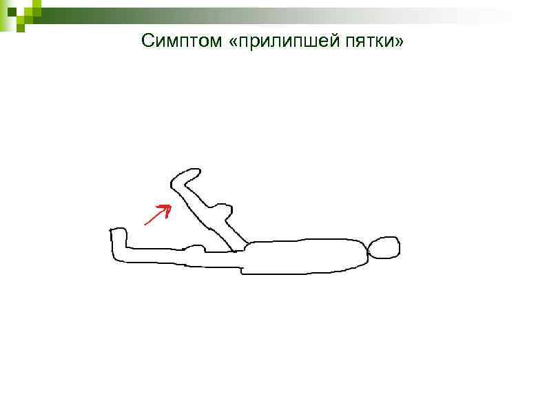 Симптом «прилипшей пятки» 