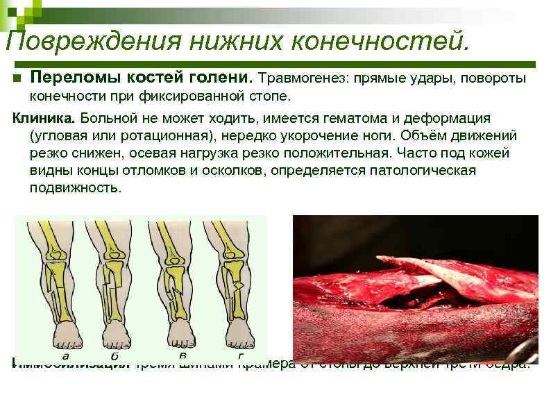 Клиническая картина переломов нижних конечностей