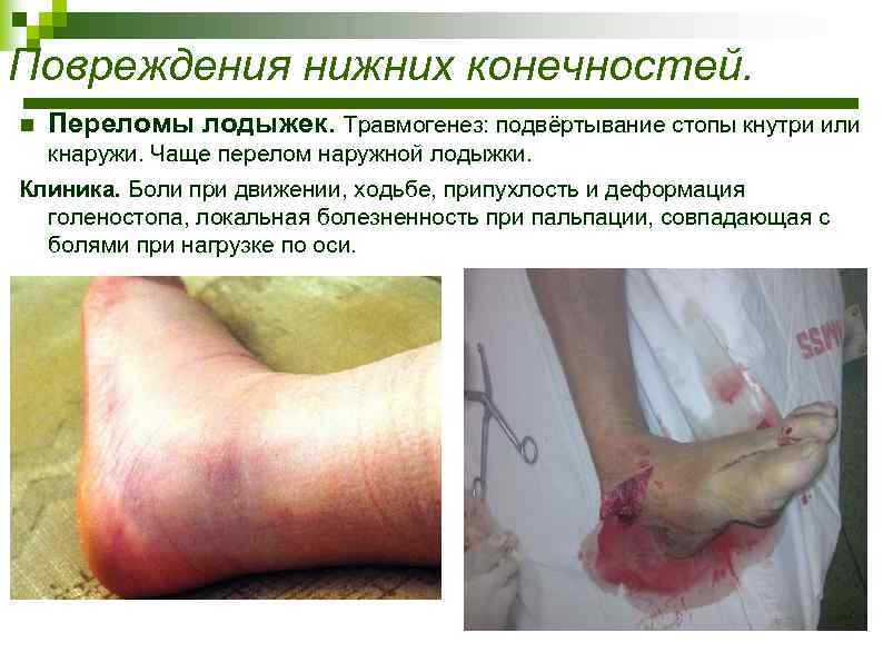 Повреждения нижних конечностей. n Переломы лодыжек. Травмогенез: подвёртывание стопы кнутри или кнаружи. Чаще перелом