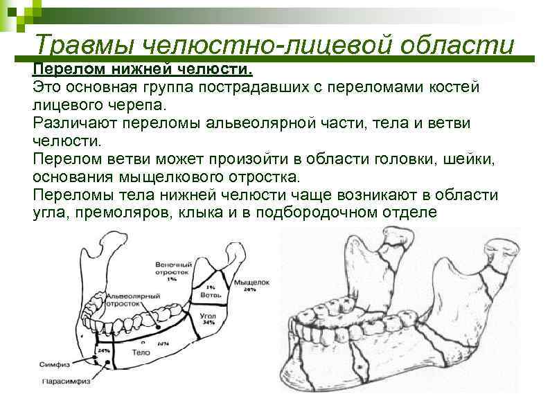 При переломе челюсти шинирование схема