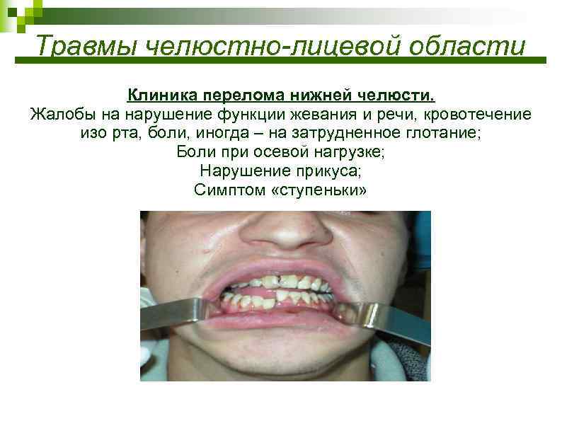Травмы челюстно-лицевой области Клиника перелома нижней челюсти. Жалобы на нарушение функции жевания и речи,
