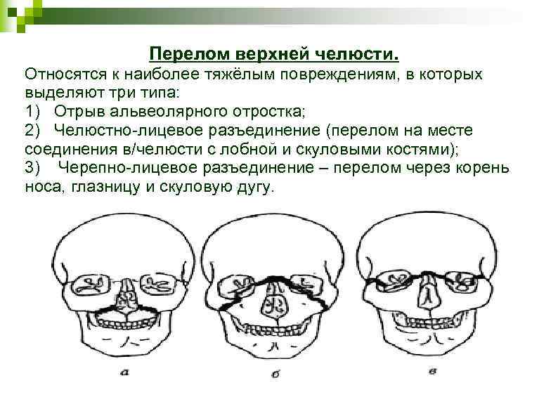 Перелом верхней челюсти презентация