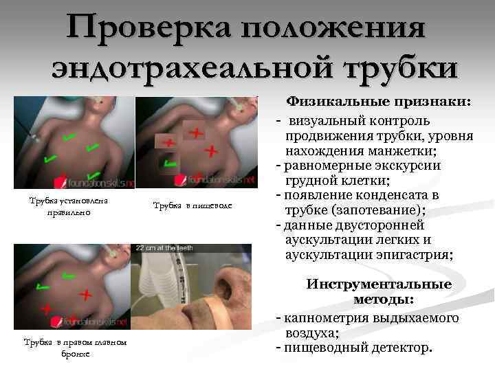 Проверка положения эндотрахеальной трубки Трубка установлена правильно Трубка в правом главном бронхе Трубка в